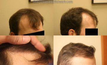 Hair restoration procedure before and after pictures