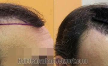 Hair restoration procedure before and after pictures