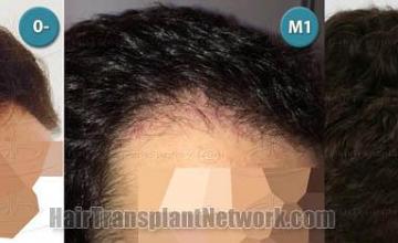 Hair restoration procedure before and after pictures