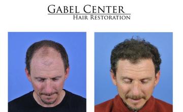 Top view - Before and after hair replacement procedure