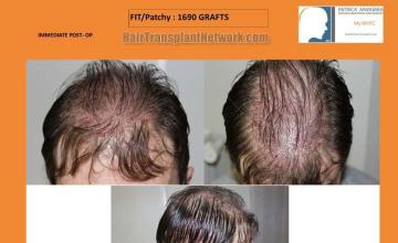 Hair transplantation surgery before and after pictures