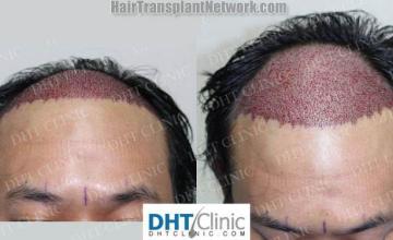 Surgical hair transplantation result photographs