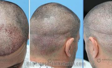 Hair Transplant Immediate postoperative images