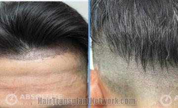 Surgical hair transplantation result photographs