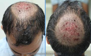 Hair restoration procedure before and after pictures