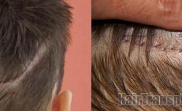 Surgical hair transplantation result photographs