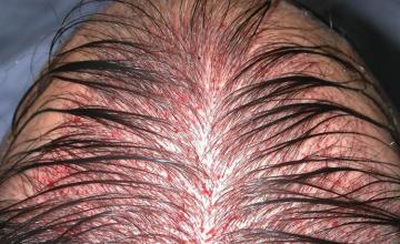 Hair restoration procedure before and after pictures