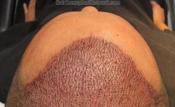 Hair restoration surgery before and after photos