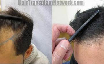Surgical hair transplantation result photographs