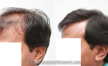 Hair transplantation surgery before and after photos