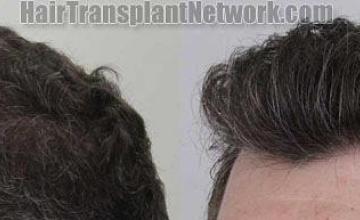 Hair transplantation surgery before and after pictures