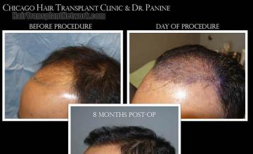 Hair transplantation surgery before and after images