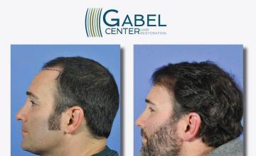 Hair transplantation surgery before and after pictures