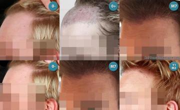  before and after photos