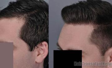  before and after photos