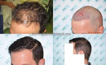 Hair transplantation surgery before and after photos