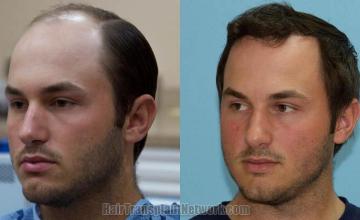 Hair transplantation surgery before and after photos