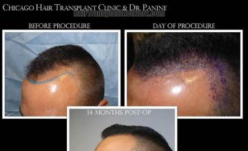 Hair restoration procedure before and after pictures