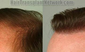 Hair restoration surgical procedure before and after pictures