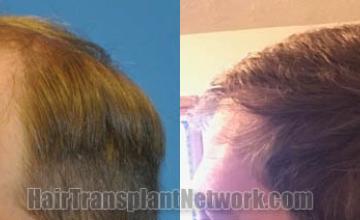 Left view -  before and after photos