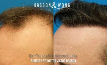 Surgical hair transplantation result photographs