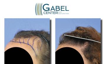 Hair transplant surgery before and after photos