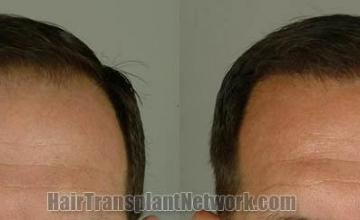 Hair transplantation surgery before and after photos