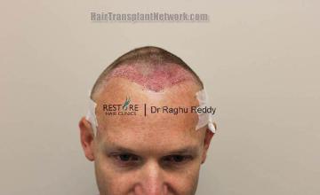 Hair transplantation surgery before and after photos