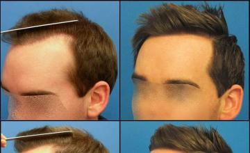 Hair restoration procedure before and after pictures