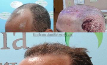 Hair transplantation surgery before and after photos