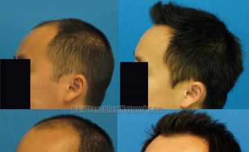 Hair transplantation surgery before and after pictures