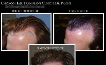 Hair transplantation surgery before and after images