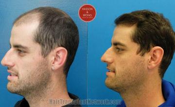 Hair transplantation surgery before and after photos