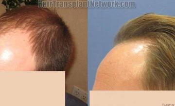 Hair transplantation surgery before and after images