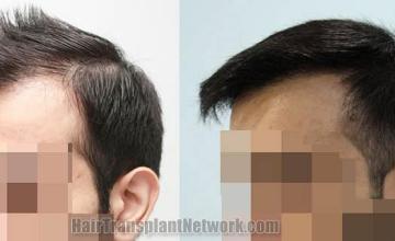 Hair transplantation surgery before and after pictures