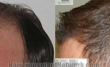 Hair transplantation surgery before and after pictures