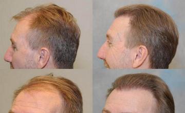 Left profile and oblique view hair transplant result pictures