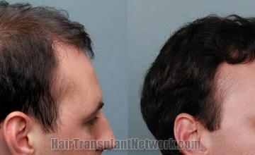 Right view before and after hair transplantation