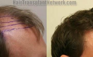 Right view before and after hair transplantation surgery