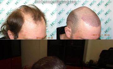 Hair restoration procedure before and after results