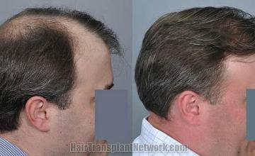 Hair transplantation surgery before and after images