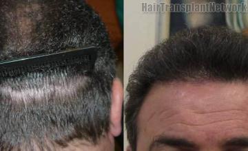 Hair transplantation surgery before and after images