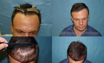 Top view before and after hair transplantation surgery