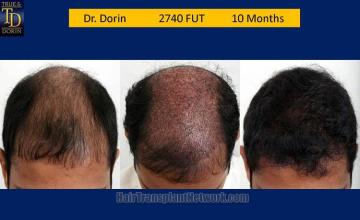 Hair transplantation surgery before and after pictures