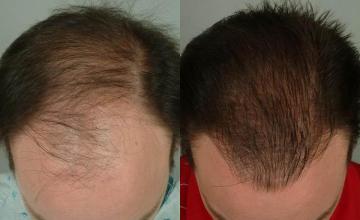 Hair restoration procedure before and after results