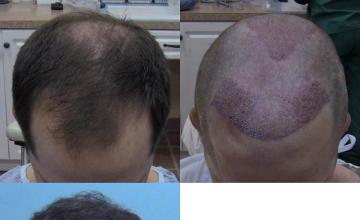 Top view before and after hair restoration results