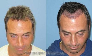 Hair restoration surgery before and after images