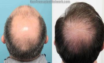 Back view before and after hair transplantation photos