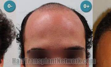 Before and after hair transplantation photographs