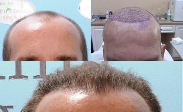 Front view - Before and after  